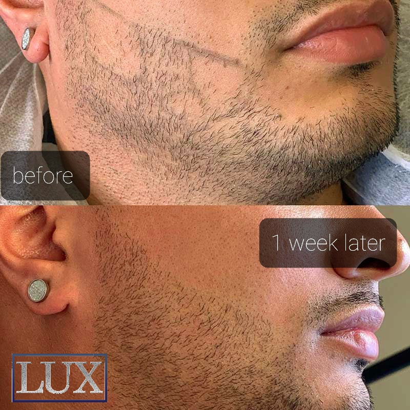 Microblading For Beards