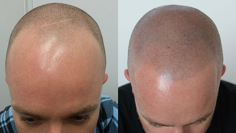 Hairline Restoration smp