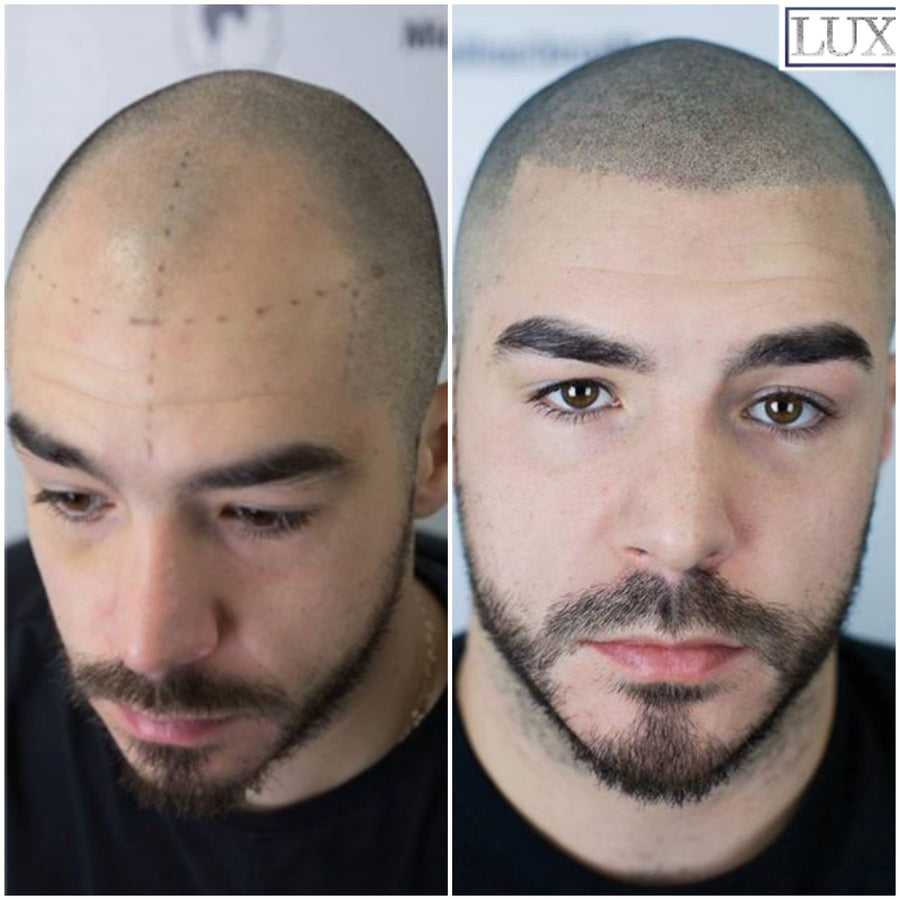Hairline Restoration 